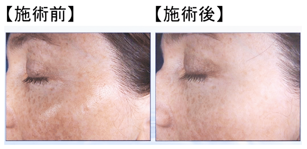 フォトシルクプラス施術例