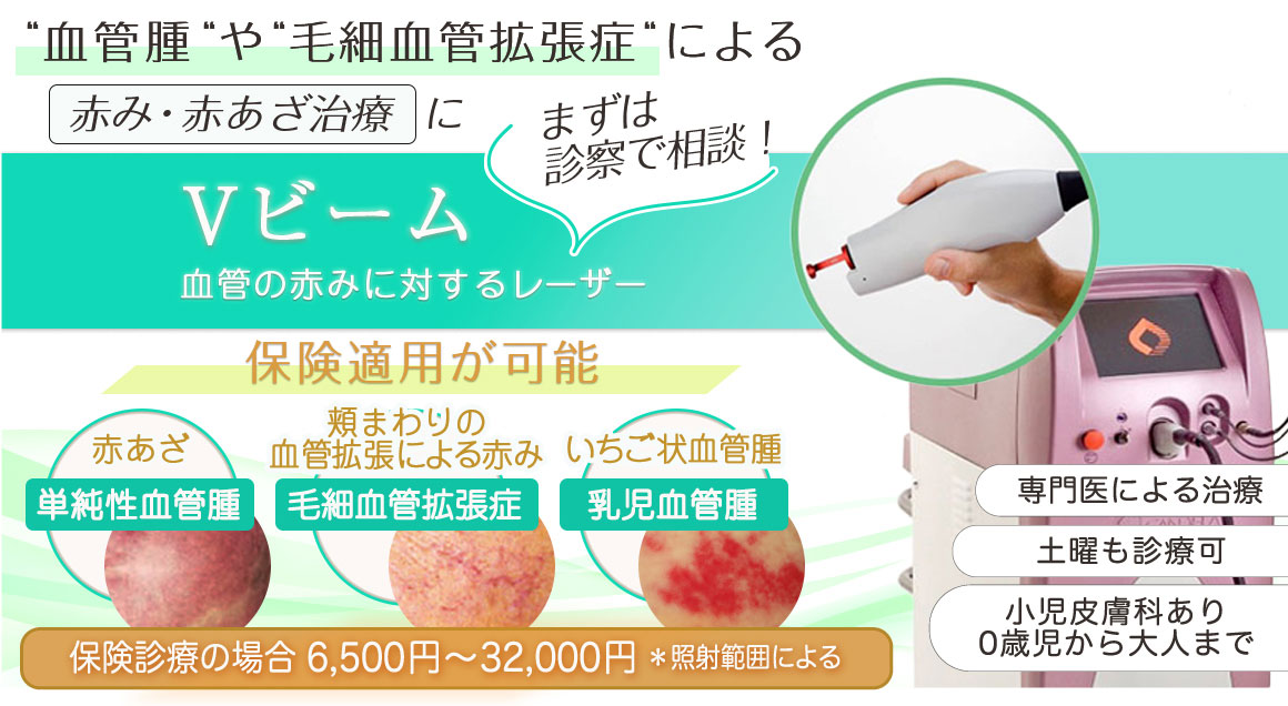 Vビーム(パルス色素レーザー)