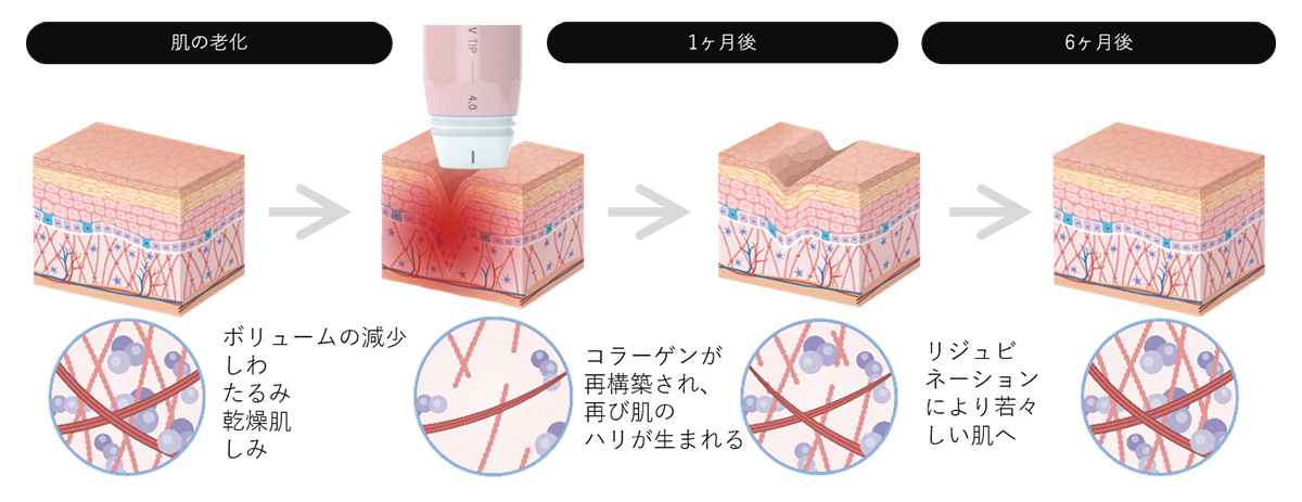 ボルニューマー　施術方法